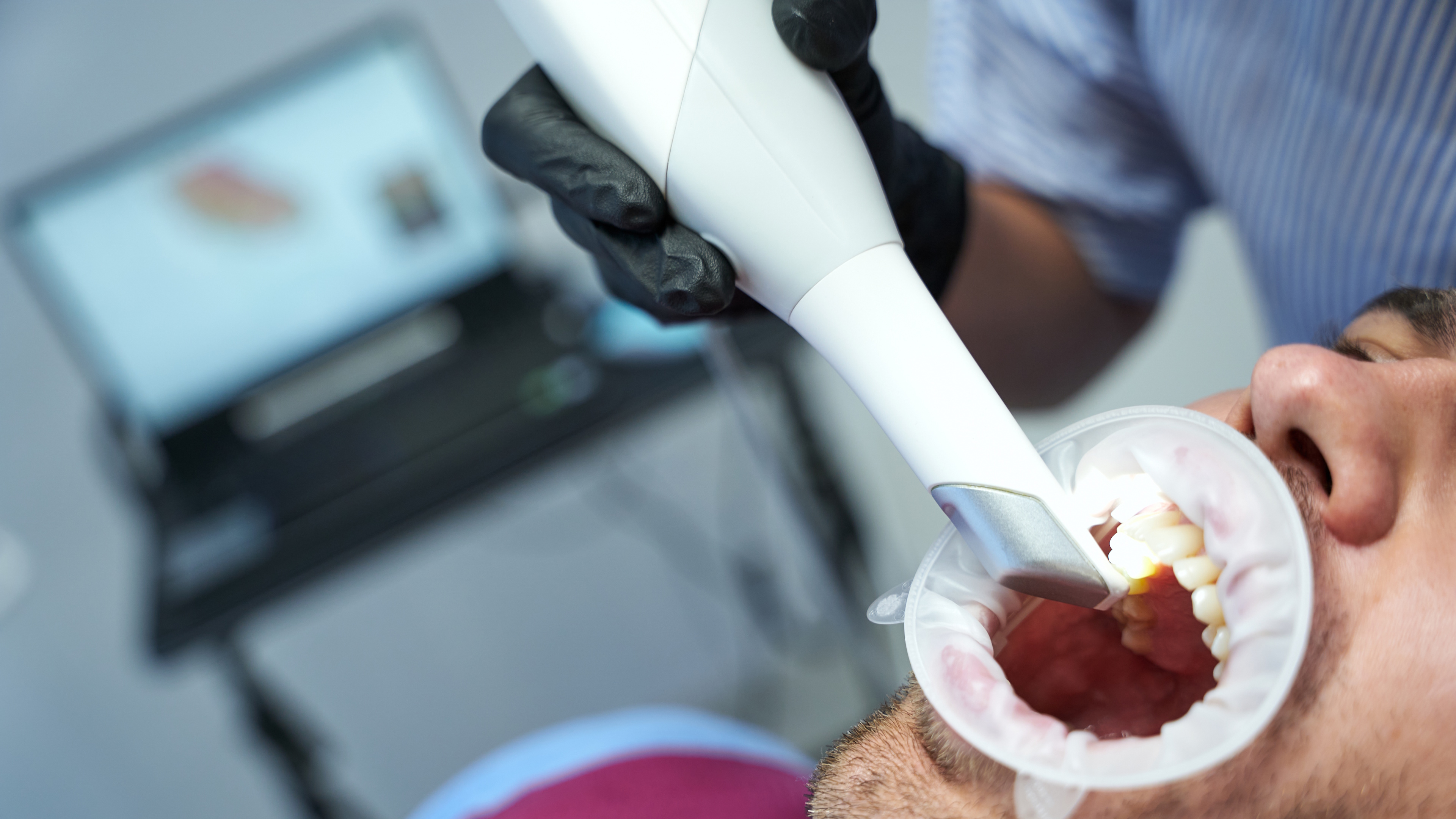 Taking Patient Impressions for Guided Surgery