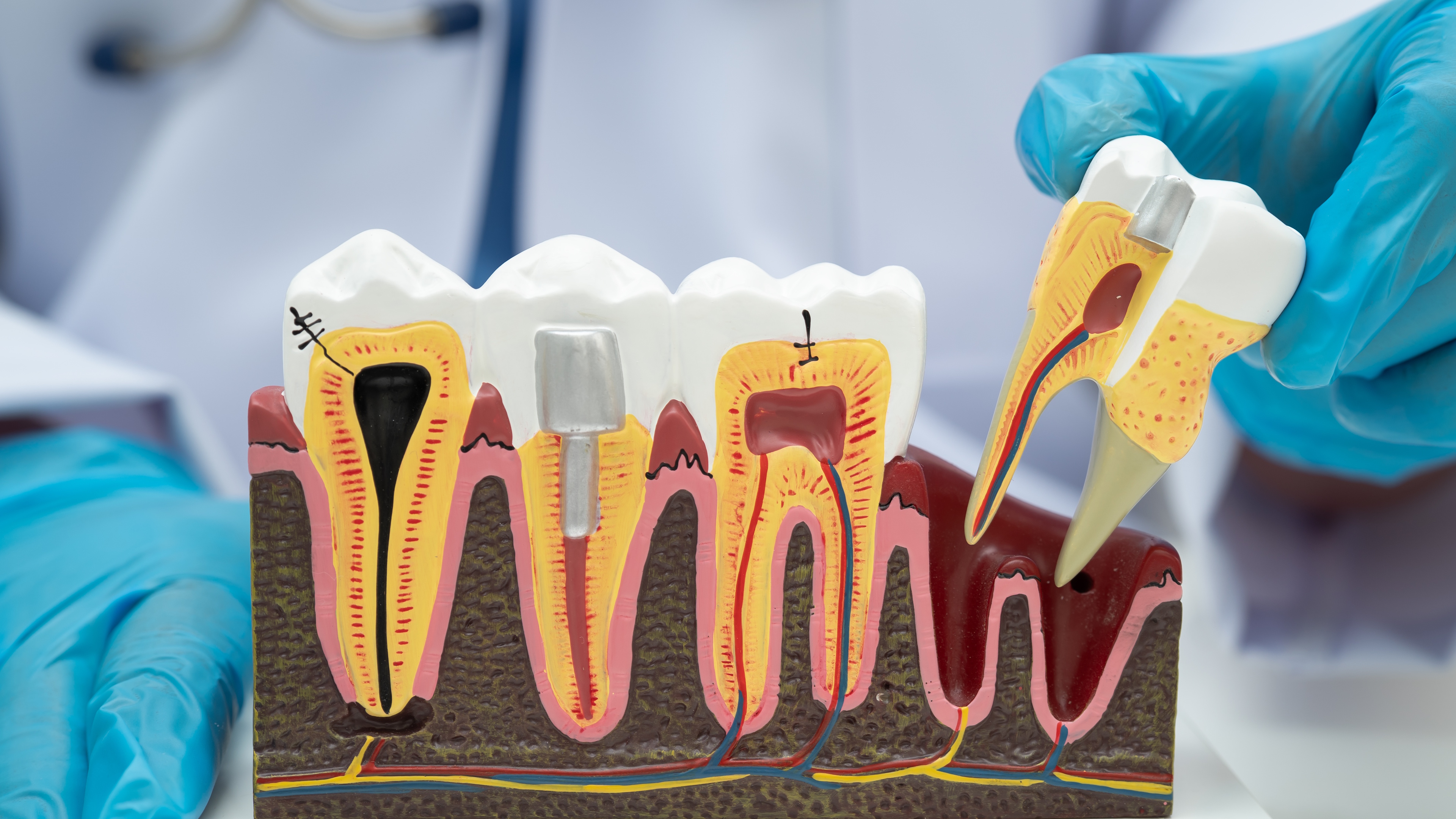 Complications Following Tooth Extraction